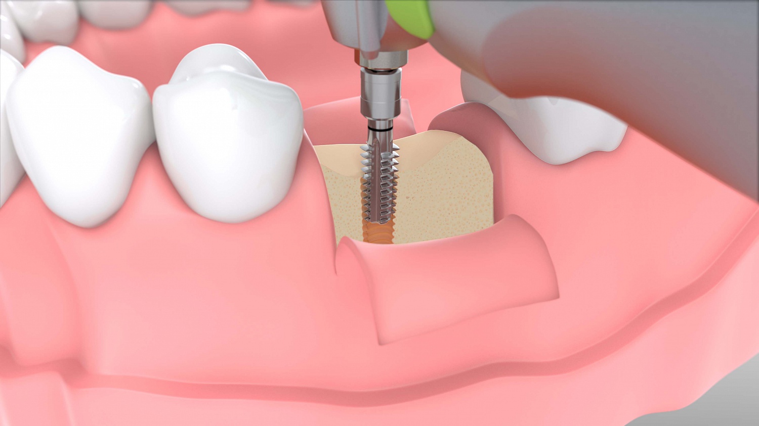 Физиодиспенсер "ImplantMED Si-1023"